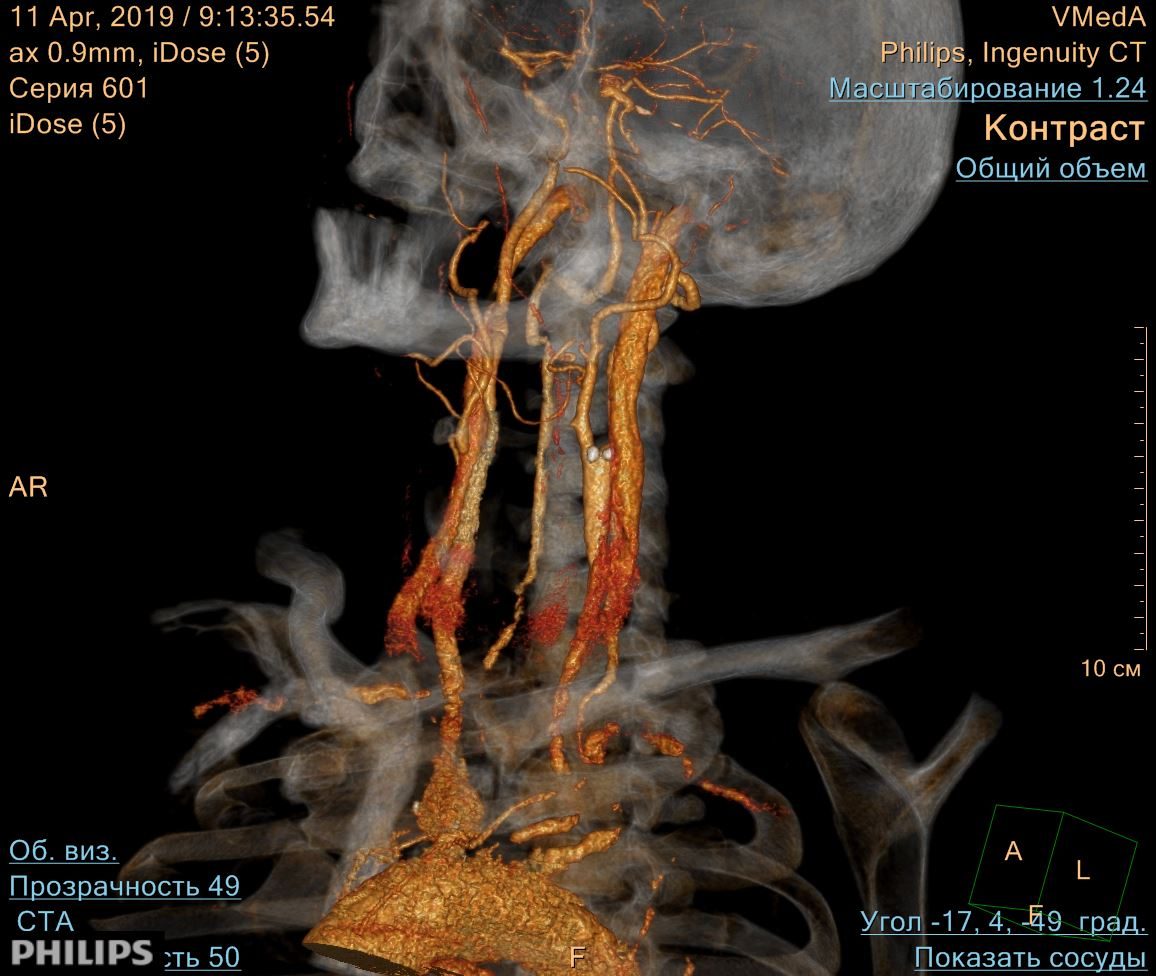 Кт сосудов головы и шеи. Брахиоцефальные сосуды на кт анатомия. Бца сосудов шеи и головного кт. Кт ангиография брахиоцефальных артерий. Кт ангиография артерий шеи.