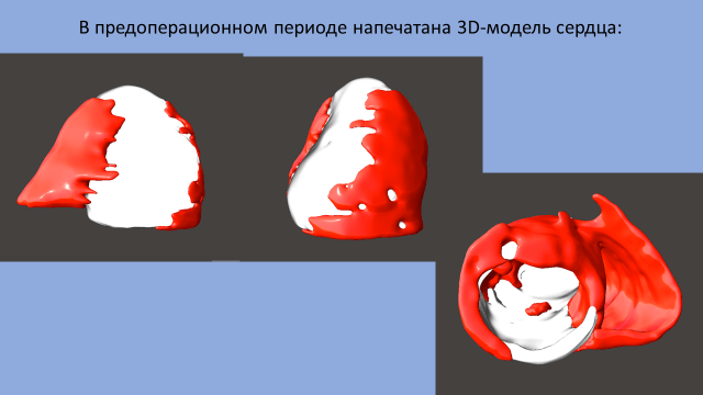 Коронарное шунтирование, резекция постинфарктной аневризмы ЛЖ в условиях искусственного кровообращения