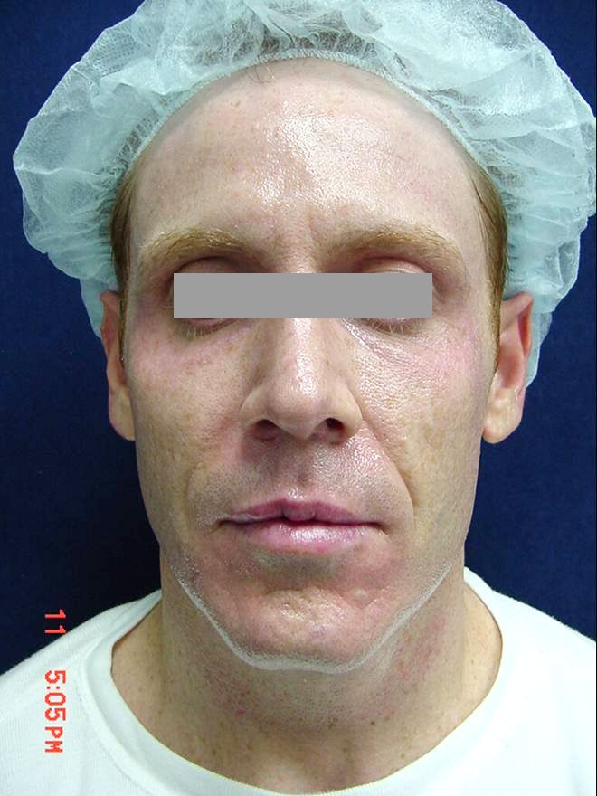 Поверхность кожи лица до процедуры
