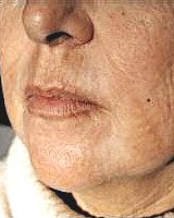 Поверхность кожи лица через 60 дней после процедуры