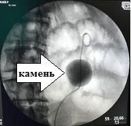Перкутанная нефролитолапаксия крупного камня левой почки