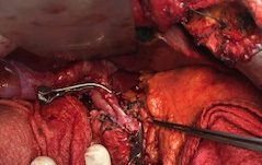 Пересадка печени при циррозе в спб