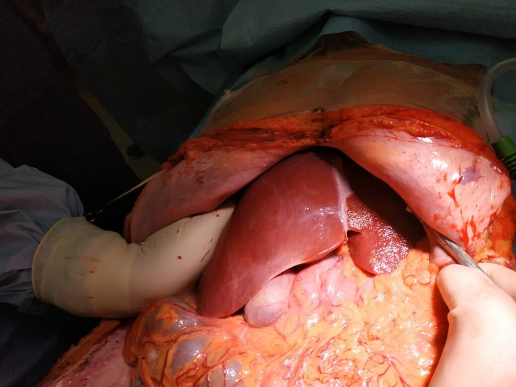 Пересадка печени при циррозе в спб