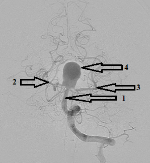 Эмболизация крупной мешотчатой аневризмы бифуркации основной артерии отделяемыми микроспиралями в условиях стент-ассистенции (Y-стентирование)