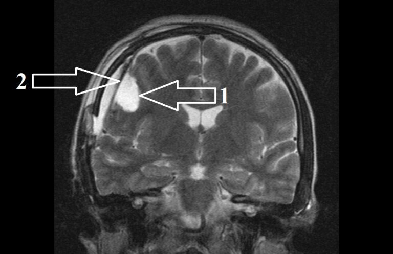 Можно делать мрт после операции. Эностоз позвоночника мрт. Мрт с контрастом кисти руки. Межпозвоночная грыжа поясничного отдела мрт. Операции на позвоночнике на кт.