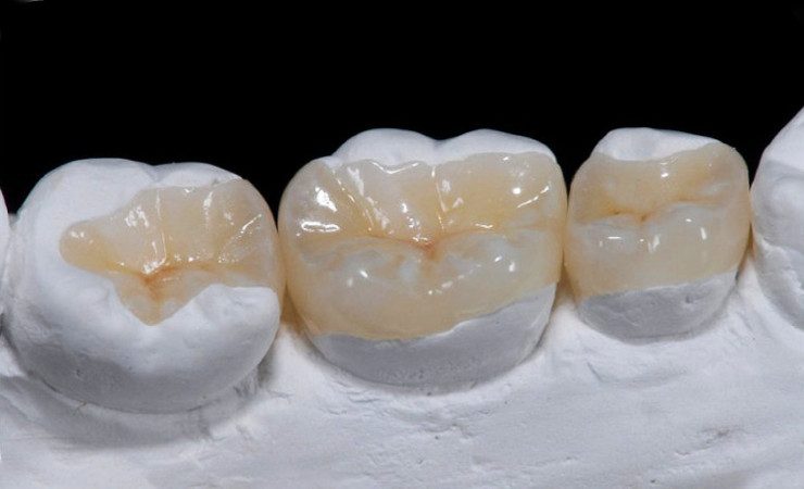 Восстановление зубов с использованием керамических вкладок