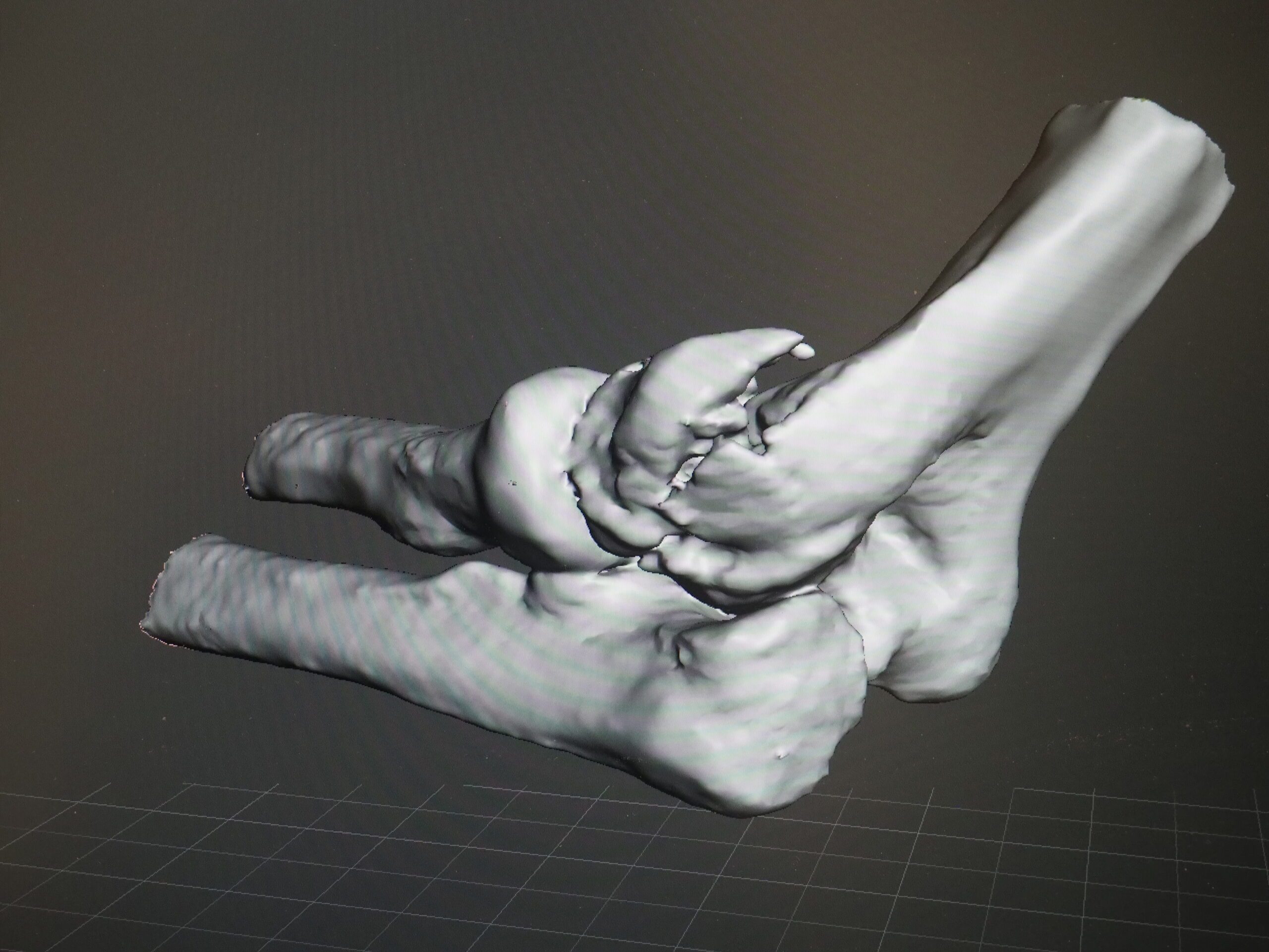 Травматологами Военно-медицинской академии успешно использованы 3D-технологии при лечении пациентов