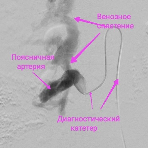 Эндоваскулярное разобщение спинальной артериовенозной фистулы на уровне LIV-LV позвонков с использованием отделяемых микроспиралей и неадгезивной клеевой композицией