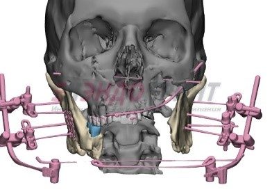 Реконструкция посттравматического минно-взрывного субтотального изъяна нижней челюсти свободным малоберцовым аутотрансплантатом на микрососудистых анастамозах