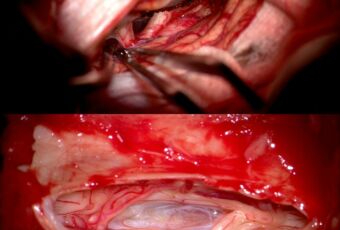 3. Интраоперационные фотограммы после удаления менингиом площадки основной кости и спинного мозга: видны сохранённые анатомические структуры головного и спинного мозга.