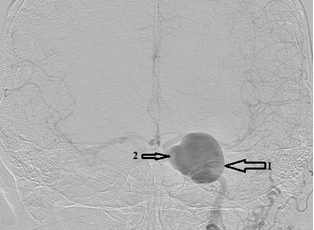 Ангиограмма левой ВСА в прямой проекции: 1-гигантская аневризма; 2-аневризма обычных размеров