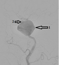Ангиограмма левой ВСА в боковой проекции: 1 - гигантская аневризма; 2 -аневризма обычных размеров.