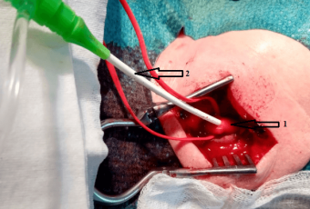 В выделенную левую ОСА (1) введен интродьюсер 6F (2)