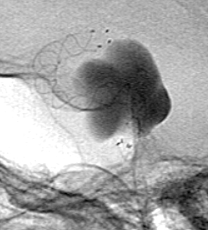 Результат операции. Ангиограмма в боковой проекции. Видны метки имплантированного и полностью расправленного стента, изменяющего направление потока крови, стагнация контрастирующего вещества в камере аневризмы.