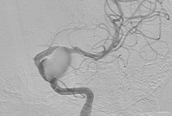 Результат операции. Ангиограмма левой ВСА в прямой проекции. Проходимость ВСА и ветвей сохранена. Контрастирование аневризмы уменьшилось.